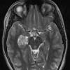 18A2 Choroid Plexus Papilloma (Case 18) T2 W 1 - Copy