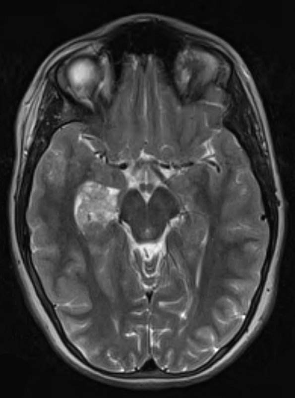 18A2 Choroid Plexus Papilloma (Case 18) T2 W 1 - Copy