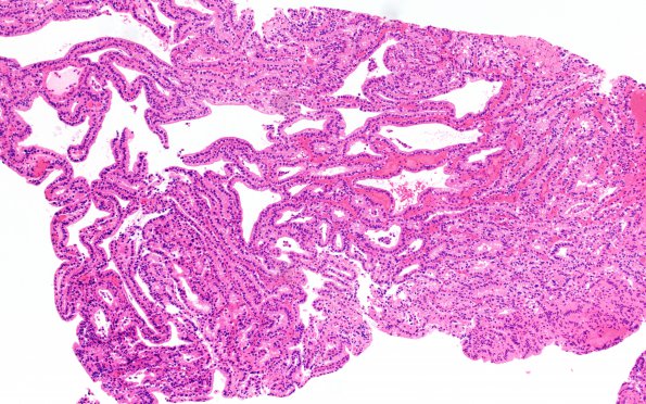 18B1 CPP (Case 18) H&E 10X