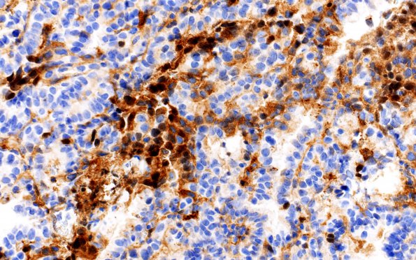 18C CPP (Case 18) Transthyretin 40X