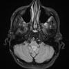 1A1 Choroid Plexus Papilloma (Case 1) FLAIR 1 - Copy