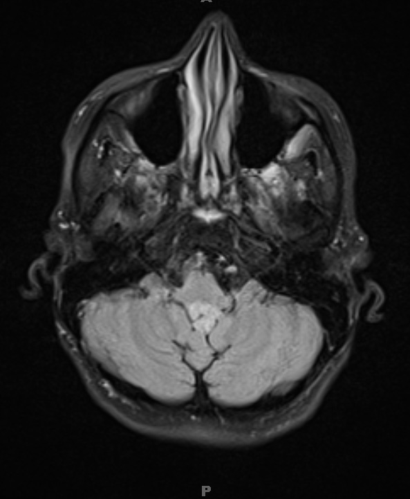 1A1 Choroid Plexus Papilloma (Case 1) FLAIR 1 - Copy