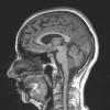 1A2 Choroid Plexus Papilloma (Case 1) T1 MPRAGE - Copy