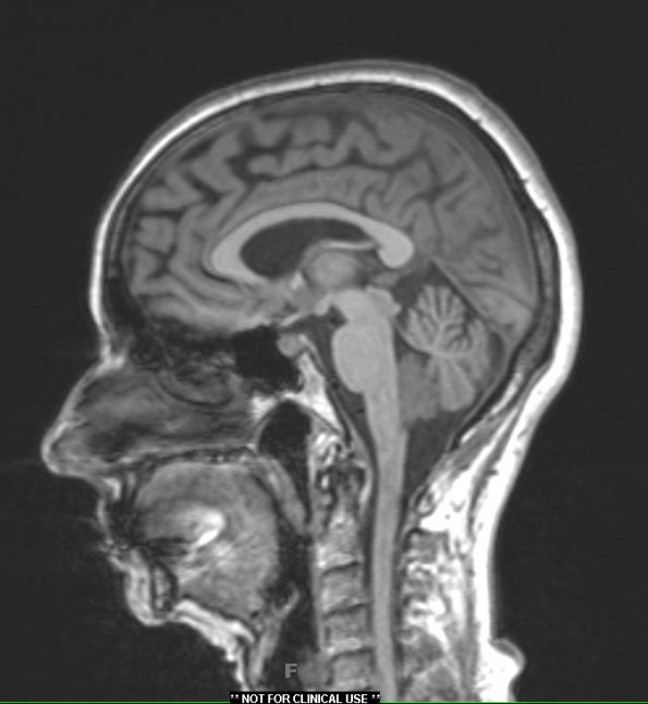 1A2 Choroid Plexus Papilloma (Case 1) T1 MPRAGE - Copy