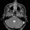 1A3 Choroid Plexus Papilloma (Case 1) T1W 1 - Copy