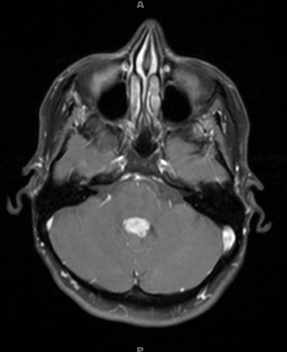 1A3 Choroid Plexus Papilloma (Case 1) T1W 1 - Copy