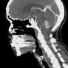 1A4 Choroid Plexus Papilloma (Case 1) T1W contrast - Copy