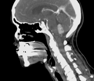 1A4 Choroid Plexus Papilloma (Case 1) T1W contrast - Copy