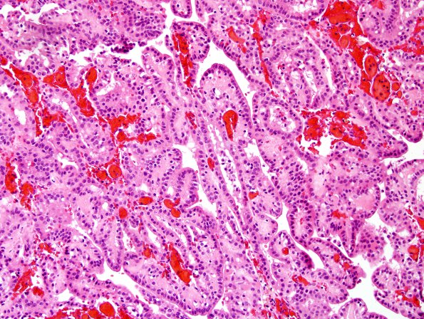 1B1 Choroid plexus papilloma (Case 1) H&E 2.jpg