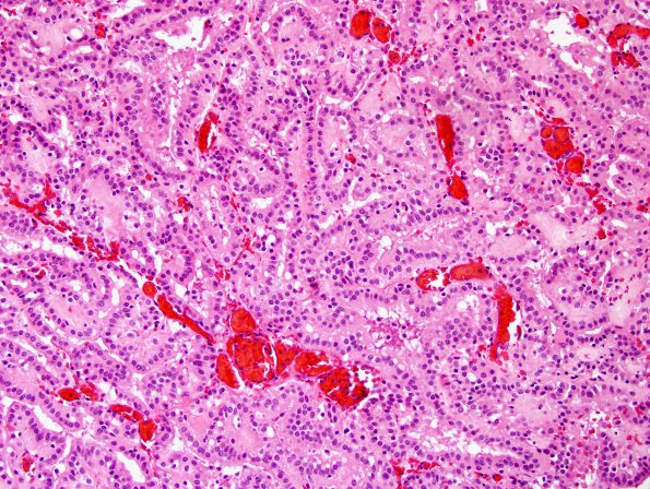 1B3 Choroid plexus papilloma (Case 1) H&E 4.jpg