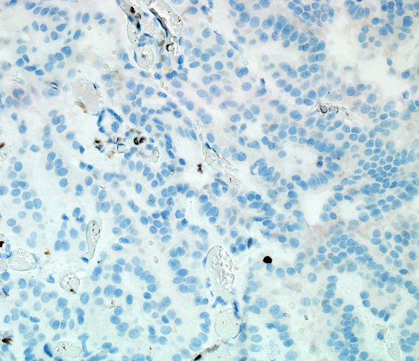 1F Choroid plexus papilloma (Case 1) Ki67 40X.jpg