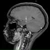 2A1 Choroid Plexus Papilloma (Case 2) T1 W 2 copy - Copy