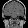 2A2 Choroid Plexus Papilloma (Case 2) T1 W 1 - Copy