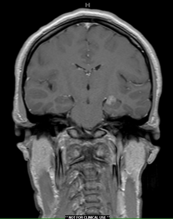 2A2 Choroid Plexus Papilloma (Case 2) T1 W 1 - Copy