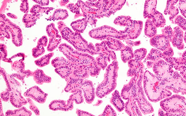 2B3 Choroid Plexus Papilloma (Case 2) H&E 2