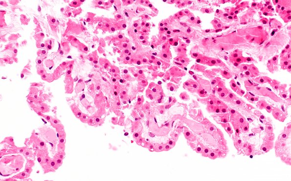 2B5 Choroid Plexus Papilloma (Case 2) H&E nl choroid 3