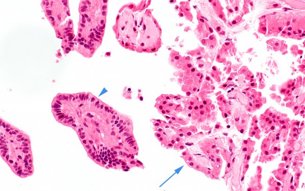 2B6 Choroid Plexus Papilloma (Case 2) H&E nl choroid & CPP 1 copy