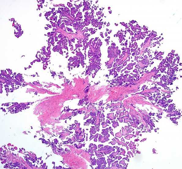 3A1 Choroid Plexus Papilloma (Case 3) H&E 8