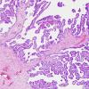 3A2 Choroid Plexus Papilloma (Case 3) H&E 5