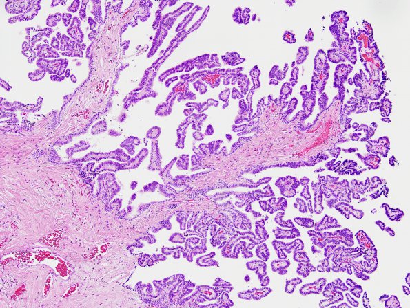 3A2 Choroid Plexus Papilloma (Case 3) H&E 5