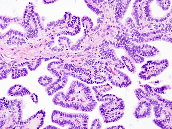 3A3 Choroid Plexus Papilloma (Case 3) H&E 2