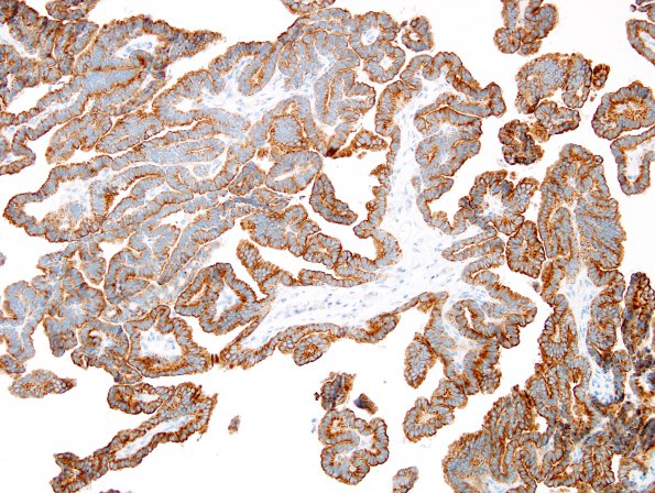 3B Choroid Plexus Papilloma (Case 3) CAM5.2 1