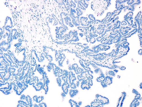 3D Choroid Plexus Papilloma (Case 3) EMA 1