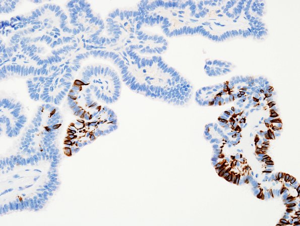 3E Choroid Plexus Papilloma (Case 3) GFAP 1