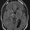 4A1 Choroid Plexus Papilloma (Case 4) FLAIR 1 copy - Copy