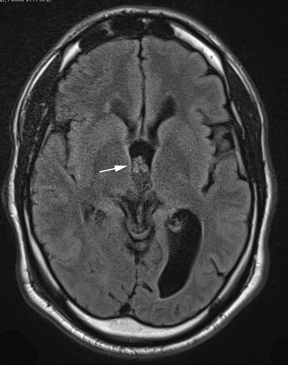 4A1 Choroid Plexus Papilloma (Case 4) FLAIR 1 copy - Copy