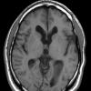 4A2 Choroid Plexus Papilloma T1 (Case 4) - Copy