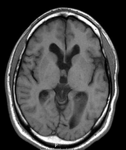 4A2 Choroid Plexus Papilloma T1 (Case 4) - Copy