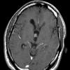 4A3 Choroid Plexus Papilloma T1W (Case 4) - Copy