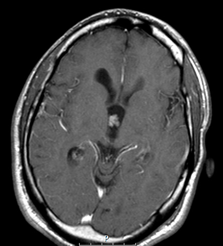 4A3 Choroid Plexus Papilloma T1W (Case 4) - Copy