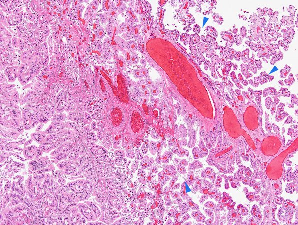 4B1 Choroid Plexus Papilloma (Case 4) H&E 2 copy.jpg