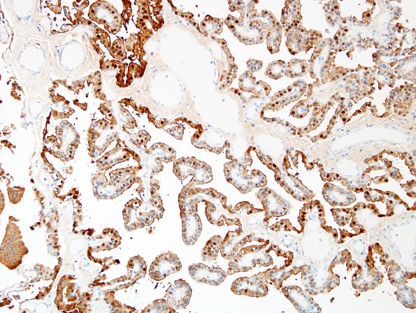 4C Choroid Plexus Papilloma (Case 4) S100 1.jpg