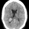 5A1 Choroid Plexus Papilloma (Case 5) CT - Copy