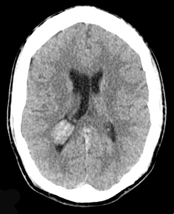 5A1 Choroid Plexus Papilloma (Case 5) CT - Copy