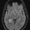 5A2 Choroid Plexus Papilloma (Case 5) TIRM 1 - Copy