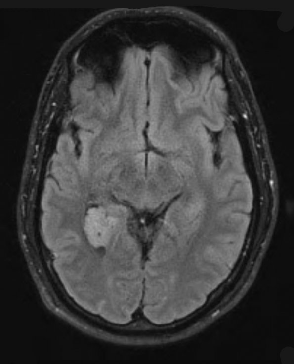 5A2 Choroid Plexus Papilloma (Case 5) TIRM 1 - Copy