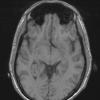 5A3 Choroid Plexus Papilloma (Case 5) T1 noC - Copy