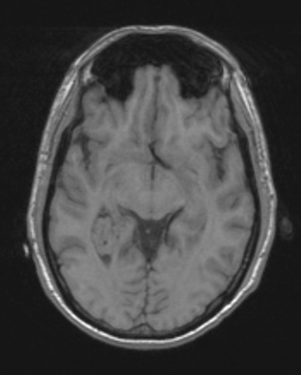 5A3 Choroid Plexus Papilloma (Case 5) T1 noC - Copy