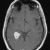 5A4 Choroid Plexus Papilloma (Case 5) T1 W 2 - Copy