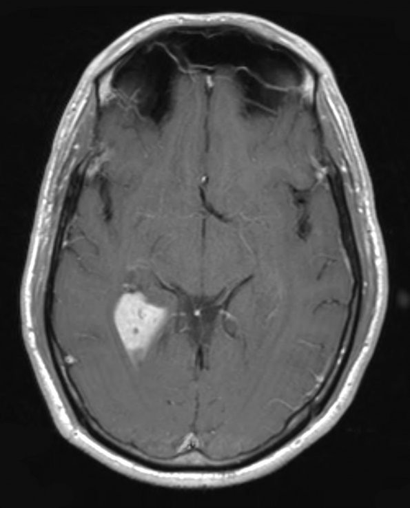 5A4 Choroid Plexus Papilloma (Case 5) T1 W 2 - Copy