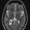 5A5 Choroid Plexus Papilloma (Case 5) T2 W 1 - Copy