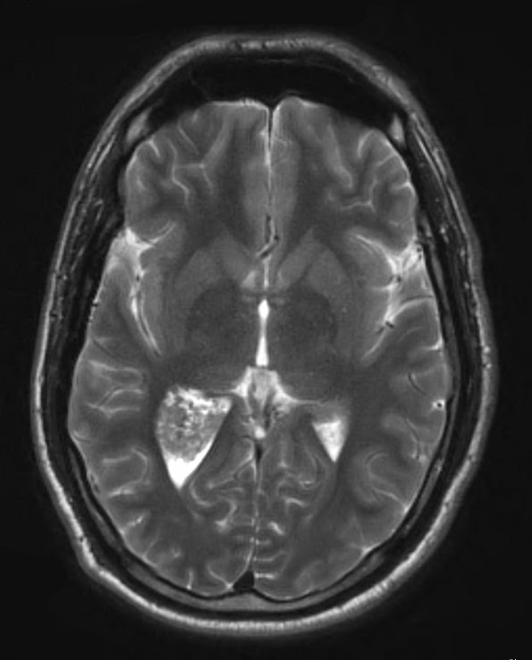 5A5 Choroid Plexus Papilloma (Case 5) T2 W 1 - Copy