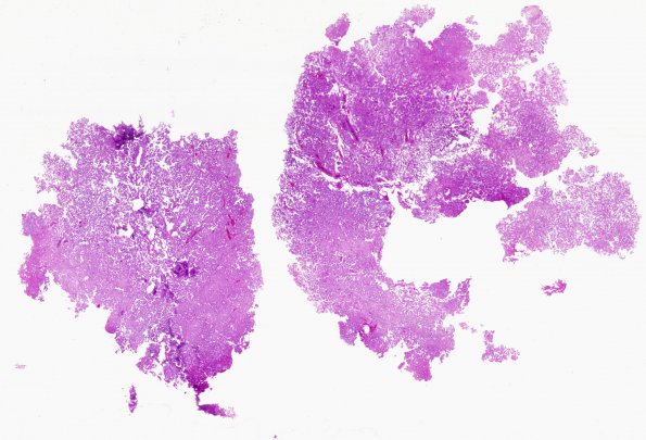 5B1 Choroid Plexus Papilloma (Case 5) H&E WM