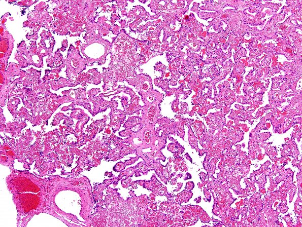 5B2 Choroid Plexus Papilloma (Case 5) H&E 1.jpg