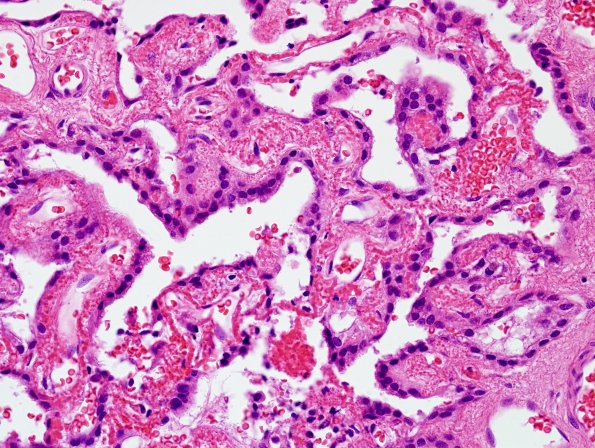 5B3 Choroid Plexus Papilloma (Case 5) H&E 3.jpg