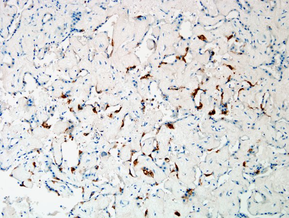 5C1 Choroid Plexus Papilloma (Case 5) S100 2.jpg